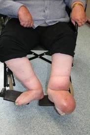 Figure 8 – Severe oedema of the legs, resulting from immobility / dependency
